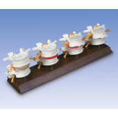 Набор четырех стадий дегенеративных изменений поясничного позвонка